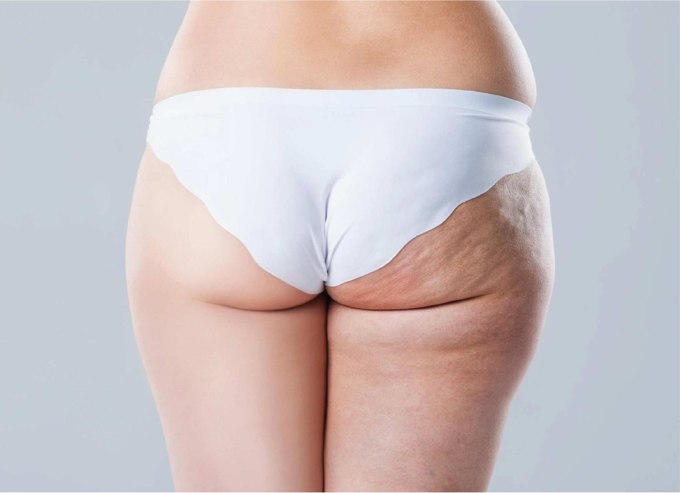 Cellulite Webinar