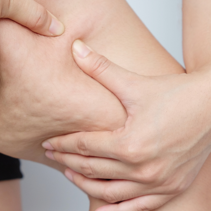 Differentiated Cellulite Treatment (DCT) Differentiated Cellulite Treatment (DCT)